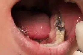 veneers, carillas, cheapest, miami, kendall, downtown, southbeach, fiu, closest to me, Dentist near me, dentista cerca de mi, best dentist miami, mejor dentista miami, pizza near me, chinese near me, food near me, crown dentist miami, cheapest dentist miami, root canal dentist miami, cheapest root canal miami